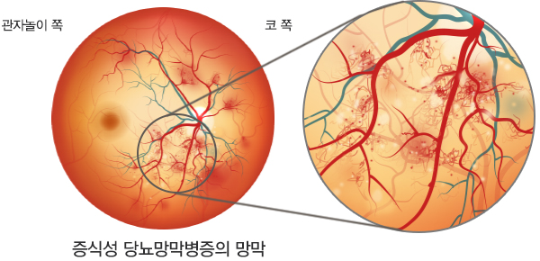 증식성당뇨망막병증의 이미지