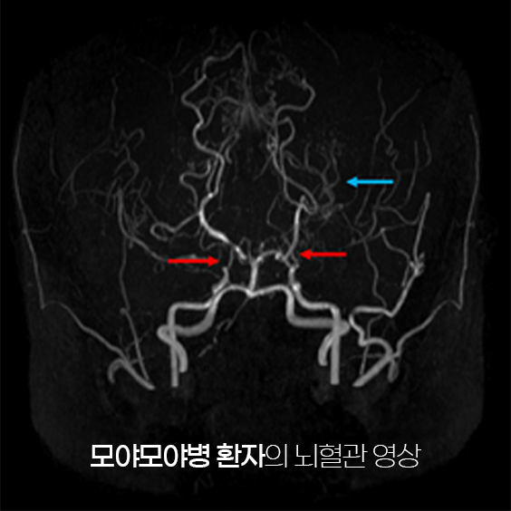 모야모야병 환자의 뇌혈관 영상