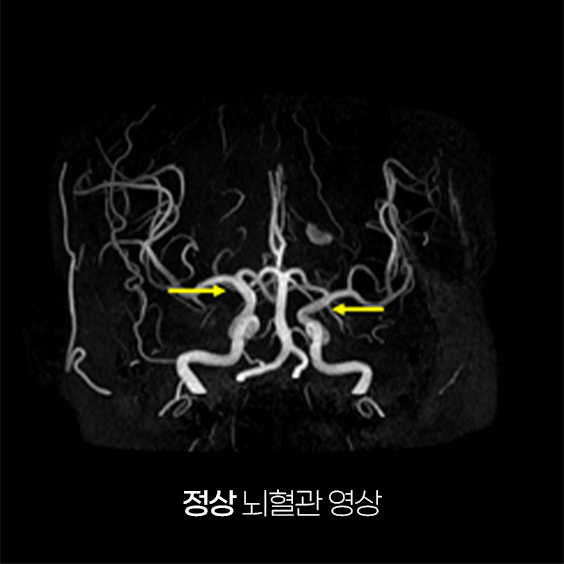 정상 뇌혈관 영상