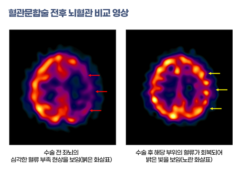 혈관문합술 전후 뇌혈관 비교 영상