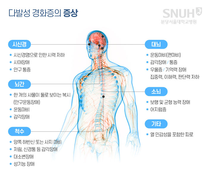 다발성 경화증의 증상. 시신경-1. 시신경염으로 인한 시력 저하, 2.시야장애, 3.안구통증, 대뇌-1.운동마비(편마비), 2.감각장애/통증, 3.우울증/기억력 장애 집중력,이해력, 판단력 저하, 뇌간-1. 한 개의 사물이 둘로 보이는 복시(안구운동장애), 2. 운동마비, 3. 감강장애, 소뇌-1. 보행 및 균형 능력 장애 2,어지럼증, 척수-1.양쪽 하반신 또는 사지마비, 저림, 신경통 등 감각장애, 대소변장애, 성기능 장애, 기타- 열 민감성을 포함안 피로