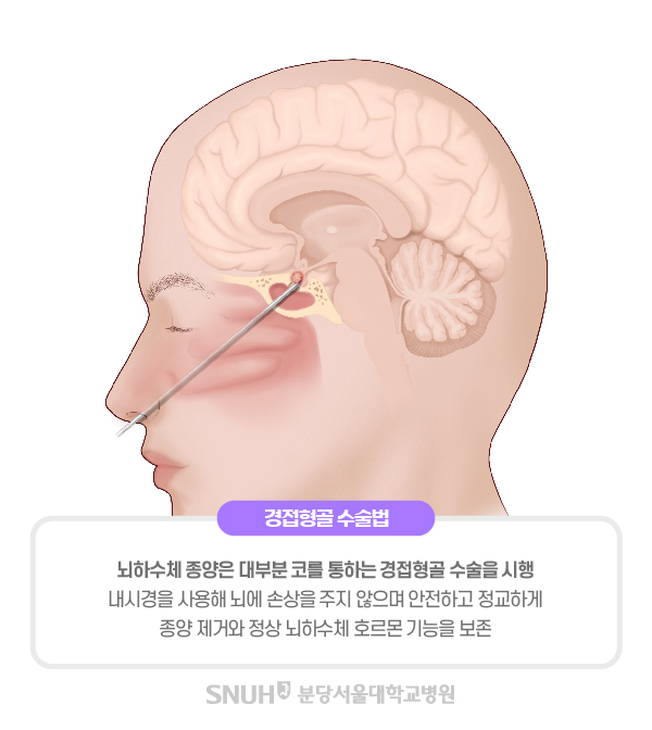경접형골 수술법. 뇌하수체 종양은 대부분 코를 통하는 경접형골 수술을 시행. 내시경을 사용해 뇌에 손상을 주지 않으며 안전하고 정교하게 종양 제거와 정상 뇌하수체 호르몬 기능을 보존