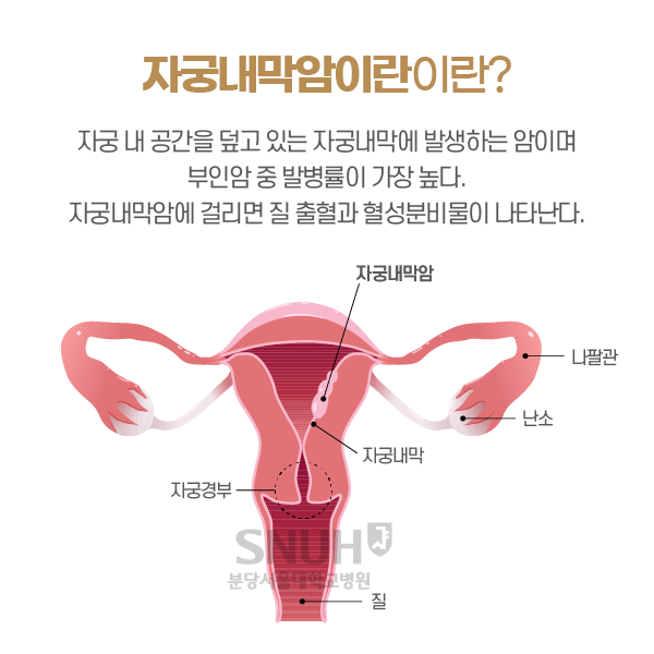 자궁내막암이란?