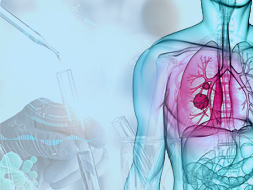 사망률 1위 폐암, 면역항암제로 치료성적 향상